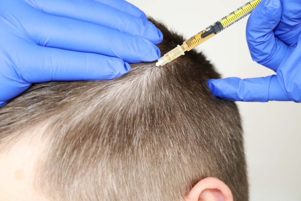 mesoterapia capilar